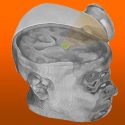 Reactivan el cerebro de un hombre en coma usando ultrasonidos