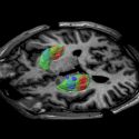 Una inyección de virus con ADN en el cerebro intenta luchar contra el Párkinson