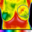 Termografía para la detección temprana de cáncer