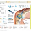 Artroscopia de rodilla