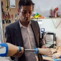Le fabricaron dos prótesis en 3D y volvió a caminar después de 5 años