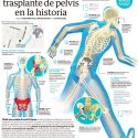 Realizan primer trasplante de pelvis en la historia