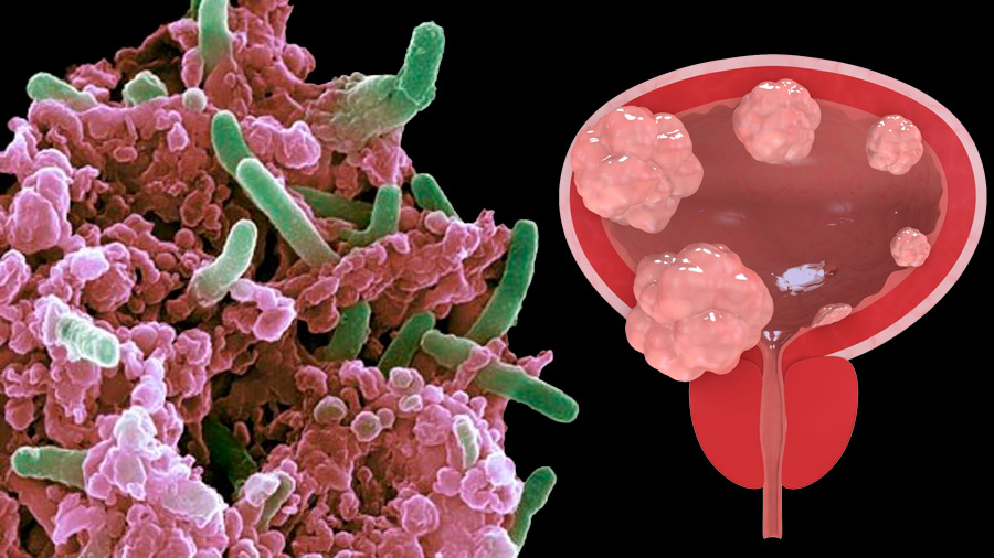 Bacterias que activan células asesinas para eliminar el cáncer de vejiga