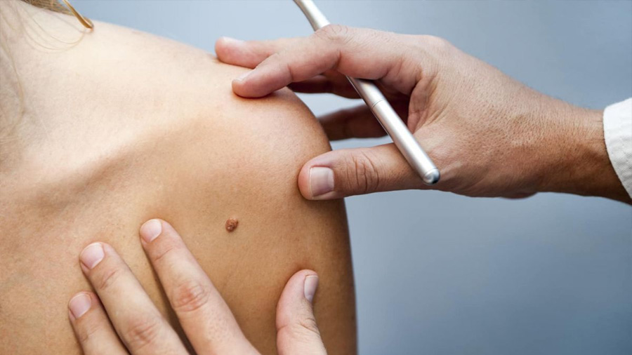 Desde California, argentino logra identificar causas del avance del cáncer de piel