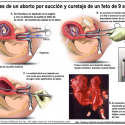 Imágenes de un aborto por sución y curetaje de un feto de 9 semanas