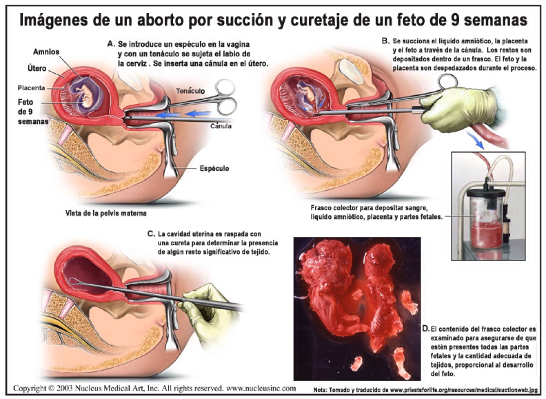 Imágenes de un aborto por sución y curetaje de un feto de 9 semanas