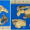 Encuentran un diminuto cerebro y un cráneo creciendo en el ovario de una adolescente