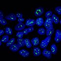 Descubren una proteína que mantiene 'dormida' la metástasis del cáncer de mama
