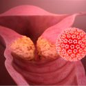 Denuncia investigadora líder la ignorancia que propaga el cáncer de cuello uterino