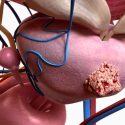 Descubren nuevas formas para atacar la metástasis del cáncer de próstata
