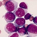 Leucemia Mieloide Aguda: hallan sistema para predecirla años antes del diagnóstico