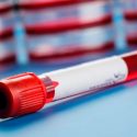 Crean el primer análisis de sangre que detecta melanomas en sus primeras fases