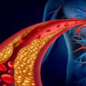 Científicos revelan cómo la obesidad causa la diabetes o las arterias obstruidas