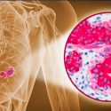 Descubren prometedor tratamiento para cáncer de mama que impide enlace entre células sanas y las tumorales