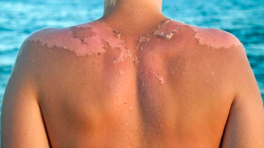 No hay bronceado saludable: qué le ocurre a la piel cuando se expone al sol