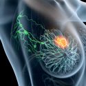 Investigadores españoles hallan los primeros indicadores para pronosticar el cáncer de mama más agresivo