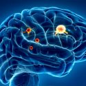 Consiguen franquear la barrera que protege a los tumores cerebrales del sistema inmune