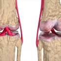Médico chileno patenta terapia contra la artrosis que desarrolló en la Clínica Mayo