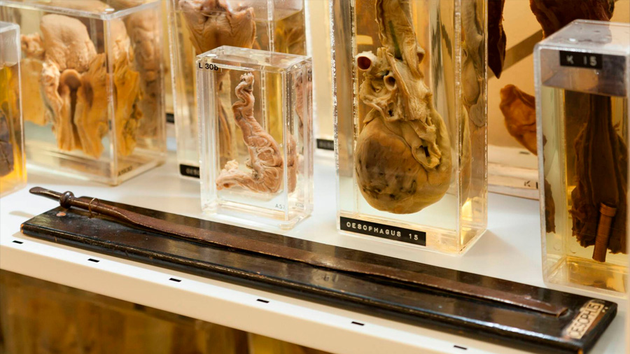 Museo de la Patología en Londres abre sus puertas por primera vez: un extraño muestrario de cuerpos enfermos