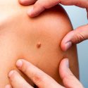 Hallado un método para evitar recaídas del cáncer más común