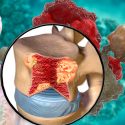 Mieloma Múltiple, el cáncer “invisible” de los mexicanos para las autoridades del país