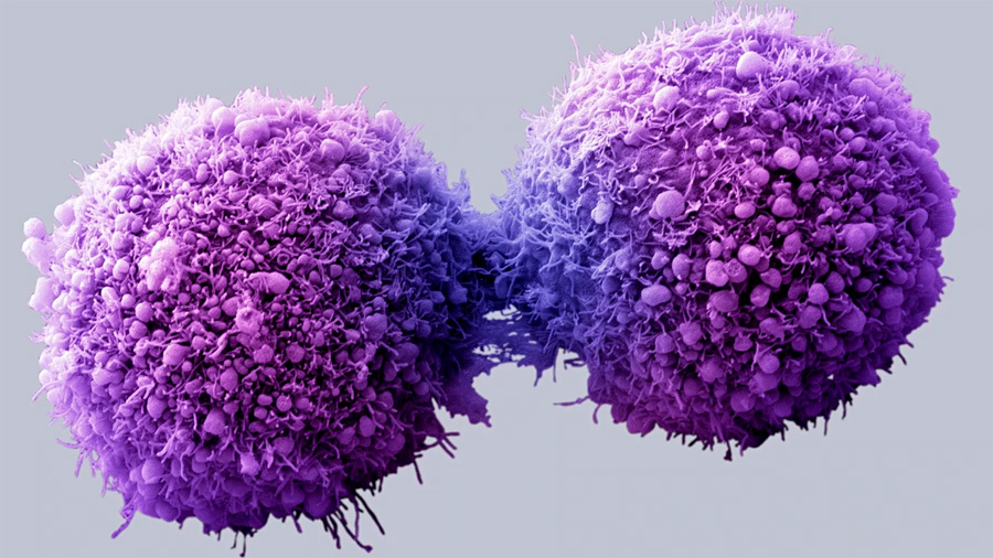 Nueva cura potencial del cáncer de páncreas mediante "células asesinas", incluso con metástasis