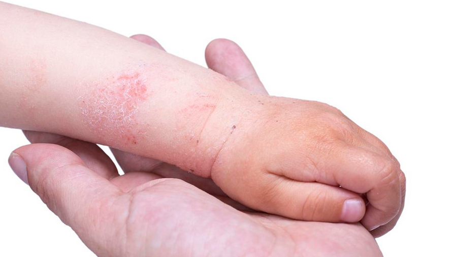 La dermatitis atópica es una de las cinco enfermedades cutánea que más afecta a los niños mexicanos
