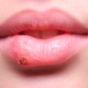 Hallan sorprendente relación del herpes simple con el alzhéimer