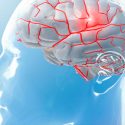Migraña: el uso excesivo de analgésicos cronifica el dolor