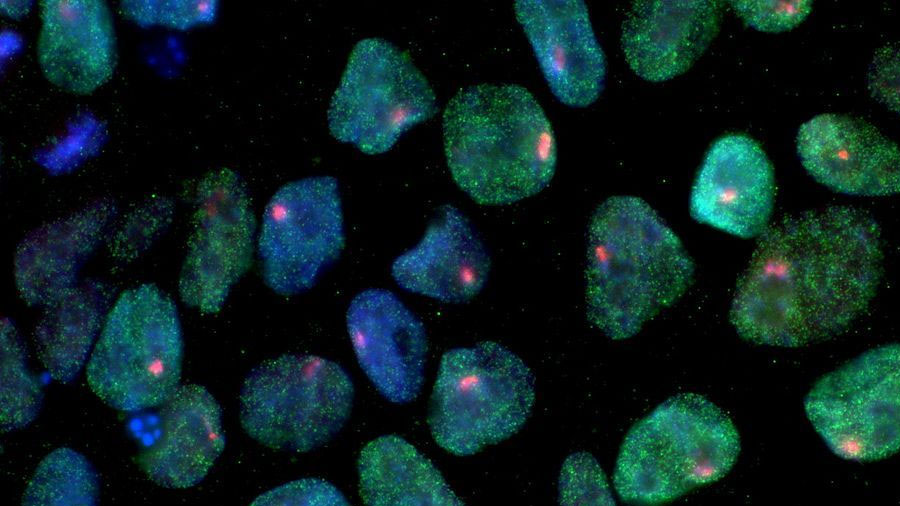 Tratan Parkinson con células madre pluripotentes inducidas
