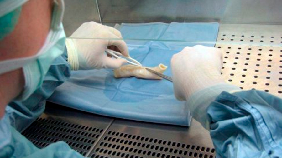 Médicos realizarán el primer trasplante de una tráquea impresa en 3D en el mundo