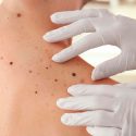 Desvelan las causas genéticas del cáncer de piel