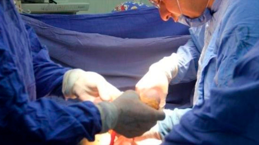 Médicos logran operar un feto fuera del vientre materno y volverlo a colocarlo dentro
