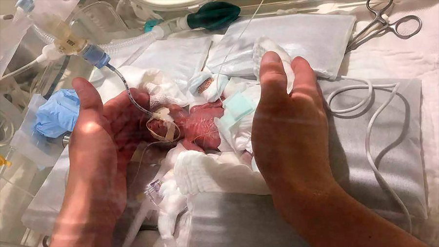 Sale del hospital el bebé prematuro más pequeño del mundo: nació en Japón pesando 268 gramos