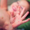 UNICEF avisa del "alarmante aumento" del sarampión en todo el mundo