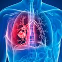 Nuevo fármaco y tratamiento para la fibrosis quística cuesta 272 mil dólares al año