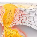 Descubren qué bacterias producen el acné