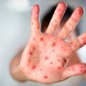 Sarampión: 8 mitos de las vacunas que pueden explicar los nuevos brotes de una enfermedad fácilmente evitable