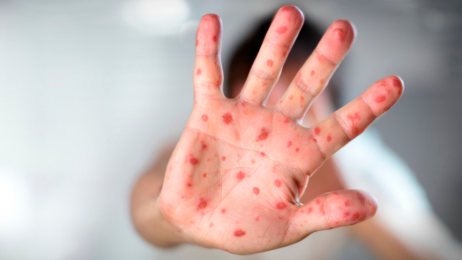 Sarampión: 8 mitos de las vacunas que pueden explicar los nuevos brotes de una enfermedad fácilmente evitable