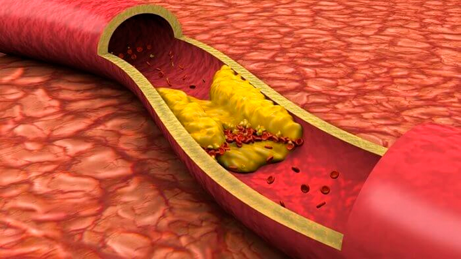 Descubren cómo el 'colesterol malo' entra en las paredes de las arterias