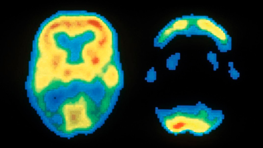 Un algoritmo predice los futuros diagnósticos de alzhéimer a partir de imágenes cerebrales