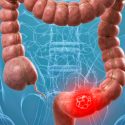 La vacuna contra el cáncer colorrectal pasó con éxito su primer ensayo en humanos