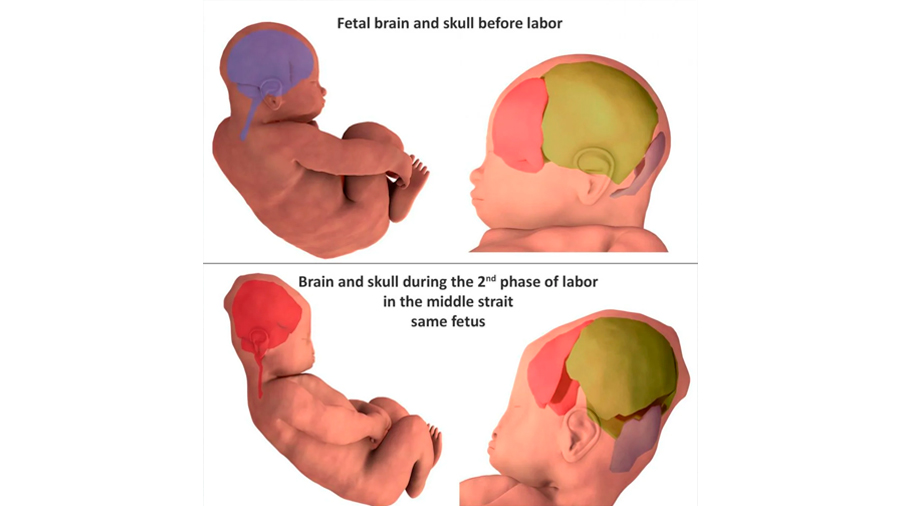 Logran captar cómo se deforma la cabeza de los bebés para facilitar el parto