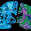 Cambios cerebrales vinculados al Alzheimer pueden aparecer hasta 30 años antes que los síntomas