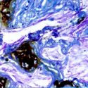 Consiguen predecir qué quistes pancreáticos pueden volverse cancerosos