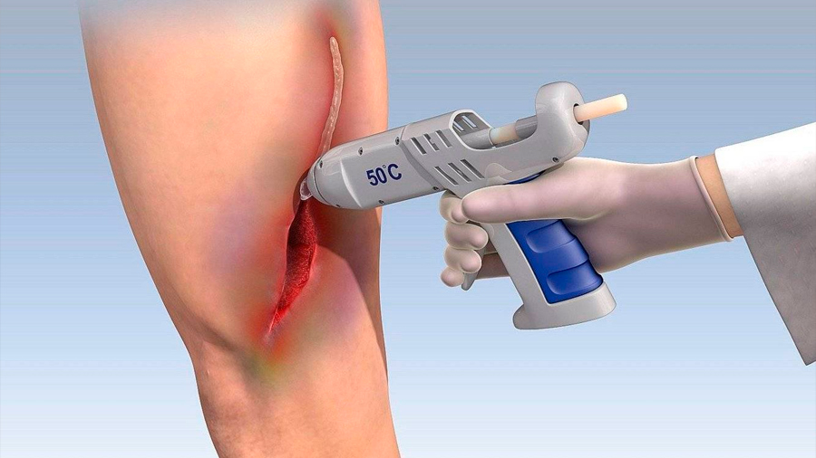 Médicos logran crear pistola de pegamento para reemplazar los puntos de sutura