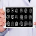 Descubren una ruta que previene la acumulación de proteína de Alzheimer en el cerebro