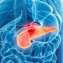 Descifran las tácticas del cáncer de páncreas para invadir tejido