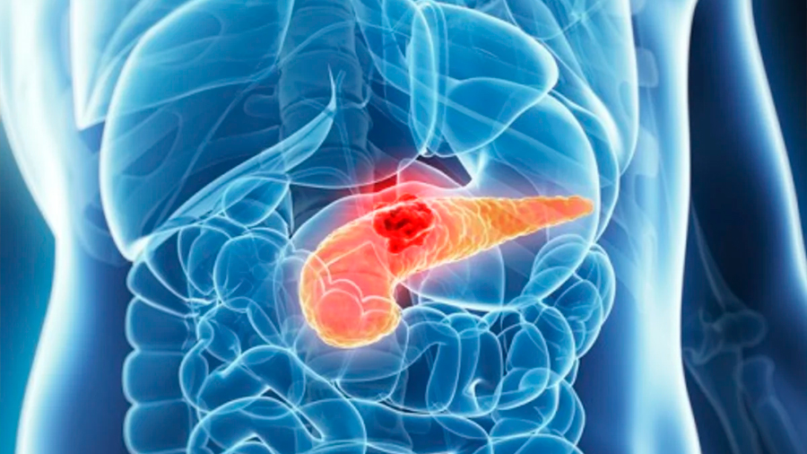 Descifran las tácticas del cáncer de páncreas para invadir tejido