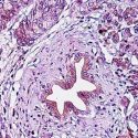 El trasplante fecal podría aumentar la supervivencia en cáncer de páncreas